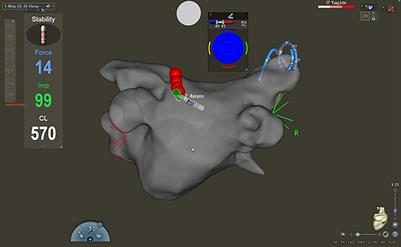 Impact of High-Power and Very High-Power Short-Duration Radiofrequency Ablation on Procedure Characteristics and First-Pass Isolation During Pulmonary Vein Isolation